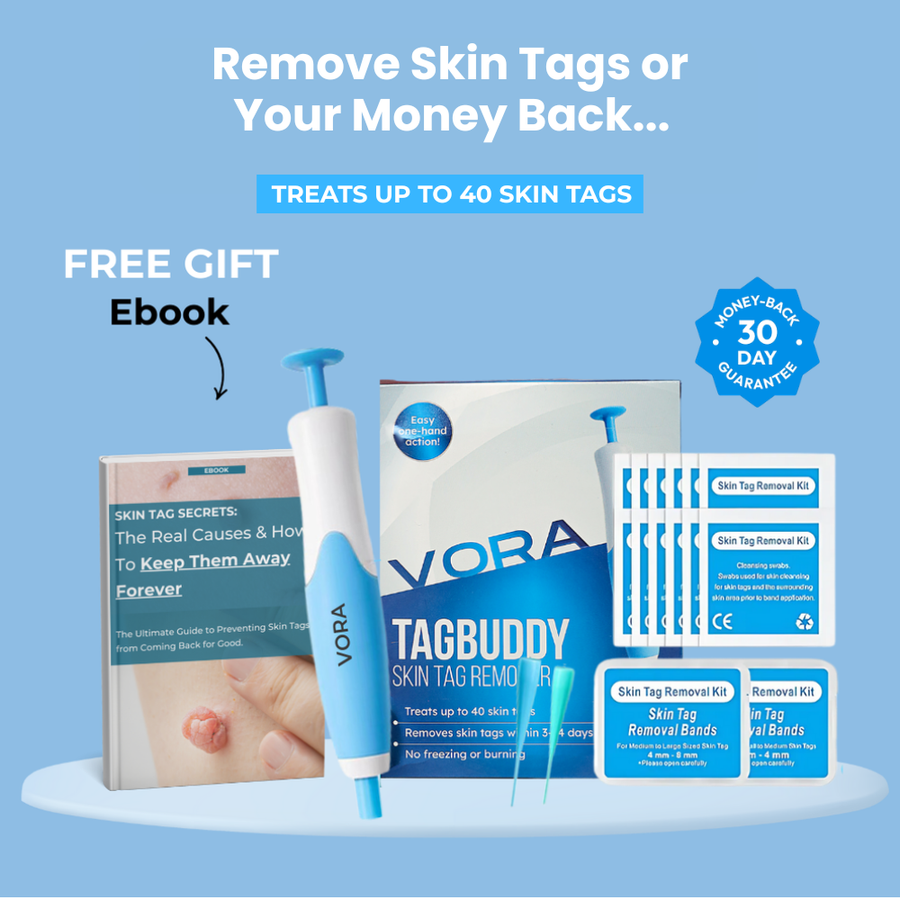 LUMIVO skin tag removal device